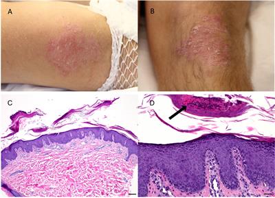 Case Report: Paraneoplastic psoriasis in thymic carcinoma